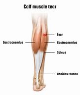 Image result for Torn Tendon in Calf Muscle