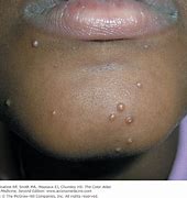 Image result for Molluscum Contagiosum On Face Treatment