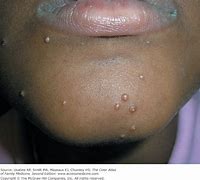 Image result for Bumps On Kids Skin Molluscum