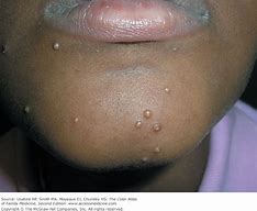 Image result for Molluscum Contagiosum Rash African American