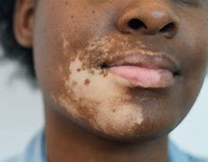 Image result for Vitiligo On White Skin