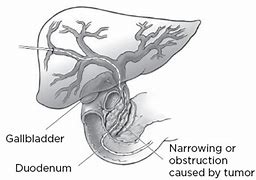 Image result for Biliary Drain Placement