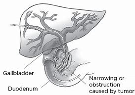 Image result for Internalized Biliary Drain