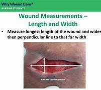 Image result for Foot Wound Measurements Undermining