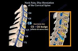 Image result for Cervical Herniated Disc Neck Pain