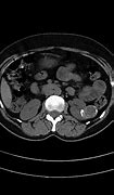 Image result for Mass On Left Kidney
