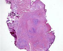 Image result for Rheumatoid Nodules Under Skin