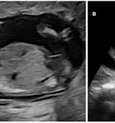 Image result for Anencephaly Ultrasound 12 Weeks