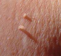 Image result for Skin Tag Wart