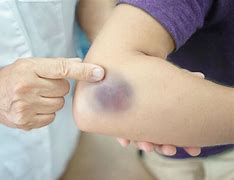 Image result for Bruise
