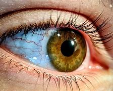 Image result for Anicteric Sclera
