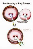 Image result for Pap Smear Procedure Drawing