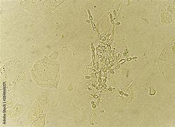 Image result for Pseudohyphae in Urine