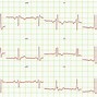 Image result for Ivcd ECG