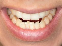 Image result for Crooked Front Teeth