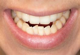 Image result for Jaw Misalignment
