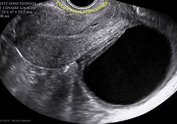 Image result for Large Tumor On Ovary