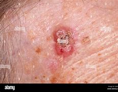 Image result for Basal Cell Carcinoma On Forehead