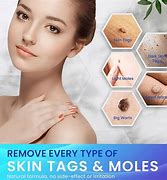 Image result for Salicylic Acid Ointment for Warts