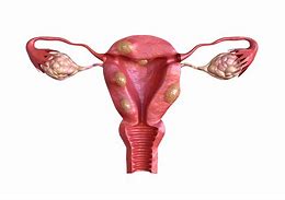 Image result for Fibroid Tumors with Teeth and Hair