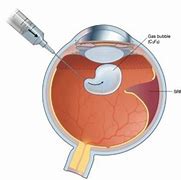 Image result for Eye Retina and Band Surgery