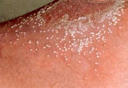 Image result for White Itchy Bumps On Skin