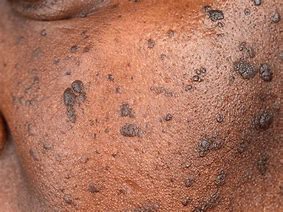 Image result for dermatosis