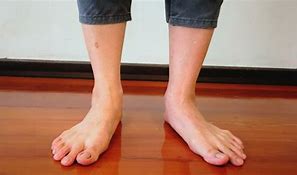 Image result for Ankle Pronation