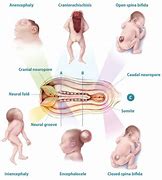 Image result for Neural Tube Defecct