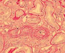 Image result for Arteriolar Nephrosclerosis