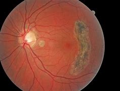 Image result for Retinal Scarring