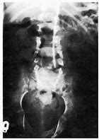 Image result for Meningomyelocele Sac