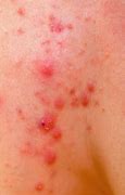 Image result for Wart On Chin