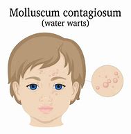 Image result for Molluscum Contagio