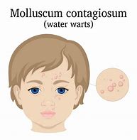 Image result for Molluscum Contagiosum Lips