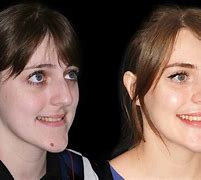 Image result for Corrective Jaw Surgery