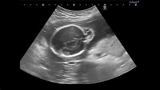 Image result for Encefalocele