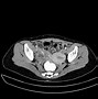 Image result for Ovarian Cyst Types