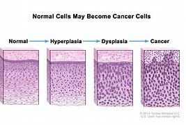 Image result for Skin Cancer Cells Under Microscope