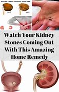 Image result for Kidney Stones Passed