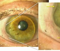 Image result for Contact Lens