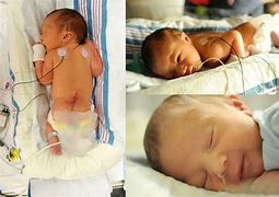 Image result for Spina Bifida Occulta in Newborn