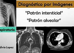 Image result for intersticial