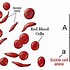 Image result for Heterozygous Type B Blood