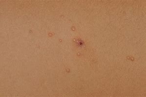 Image result for Popping Molluscum Contagiosum