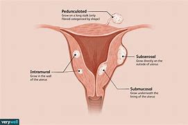 Image result for Posterior Subserosal Fibroid