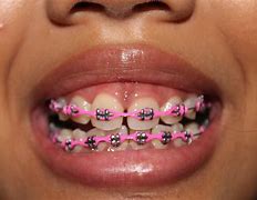 Image result for Girls with Pink Braces