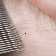 Image result for Lice On Humans