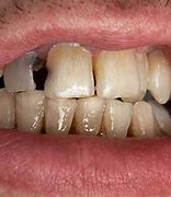 Image result for Decayed Teeth