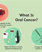 Image result for Oral Cancer HPV
